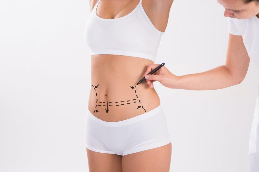 Tummy Tuck Abdominoplasty Connecticut - Amazing Results from Tummy