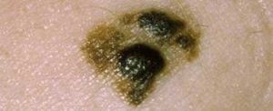 Symmetry-mole