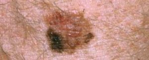 colour-mole