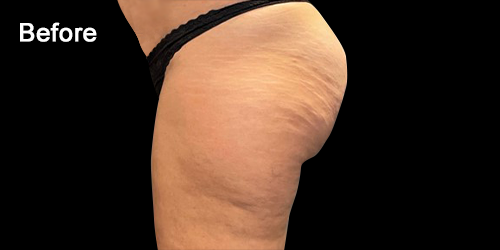 Cellulite Treatments - Before & After Images - The Private Clinic
